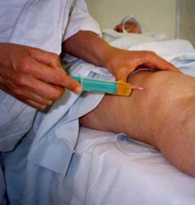 Пункция при заболевании синовита колена