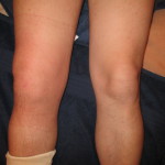Каким должно быть грамотное лечение артрита коленного сустава