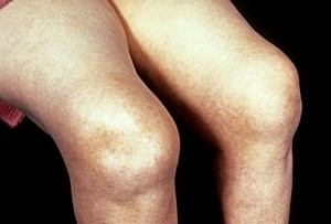 внешний вид артрита коленного сустава у ребенка
