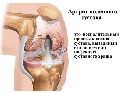 Что из себя представляет артрит коленного сустава
