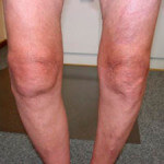 Остеоартроз второй степени коленного сустава