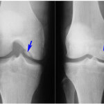 Симптоматика и лечение остеофитов коленного сустава