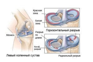 Левый коленный сустав