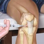 Воспаление коленного сустава: диагностика, симптомы и лечение