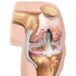 Основные симптомы остеартроза колена