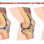 Операция на колене при бурсите