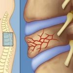 Особенности лечения и реабилитации после компрессионного перелома грудного отдела