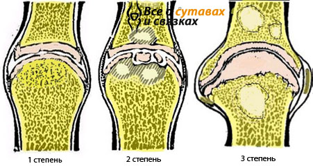 Схематичное изображение степеней остеоартроза