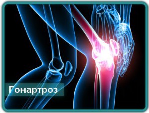 Гонартроз - причина сильных болей в колене
