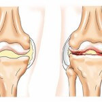 Симптомы и лечение шипов в коленном суставе