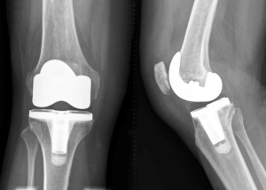 Рентген снимка искуственного протеза