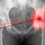 Почему остеопороз тазобедренного сустава вызывает боль