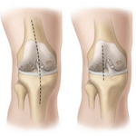 Замена коленного сустава, анализ операции